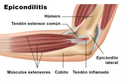 LESIONES DEPORTIVAS – Codo de tenista, cómo aliviar la epicondilitis (1era. parte)